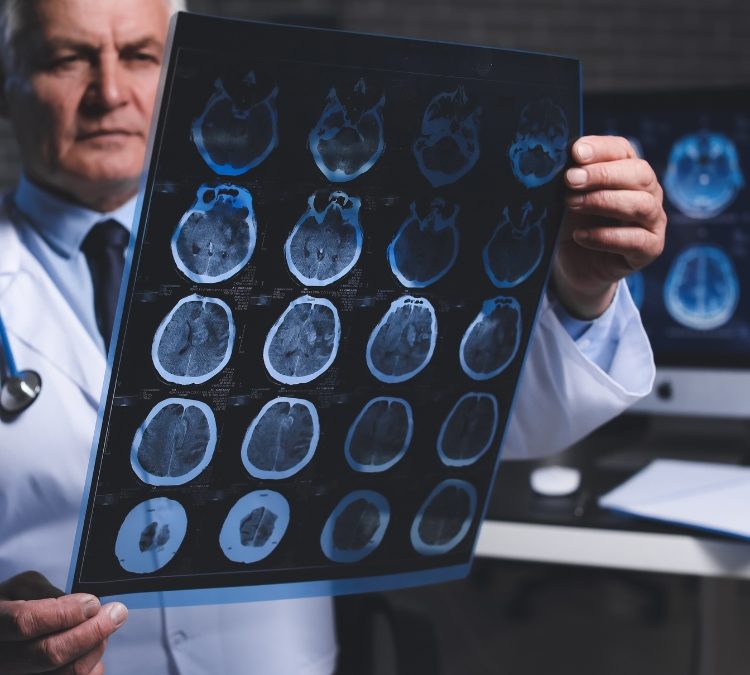 What is a Stroke? | Symptoms & Treatment | Midvaal Hospitaal